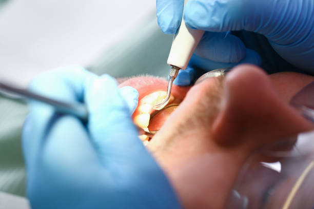 Best Broken or Cracked Tooth Emergency Dentist in Cisco, TX